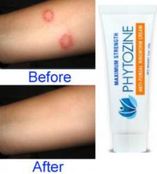 Ringworm Treatment with Phytozine