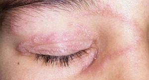 ringworm eye