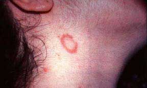 ringworm-in-children