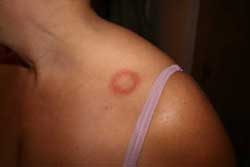 ringworm-in-women