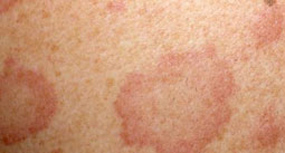 ringworm is infectious